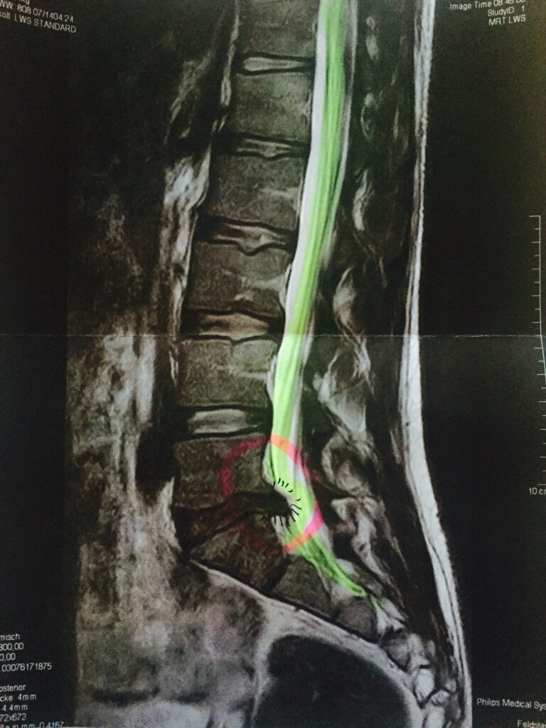 CT-Bild eines Bandscheibenvorfalls